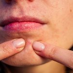 best pimple treatment in bangalore